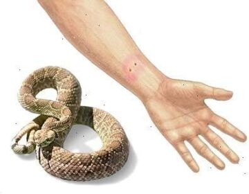 Yılan akrep Isırığı Kiti